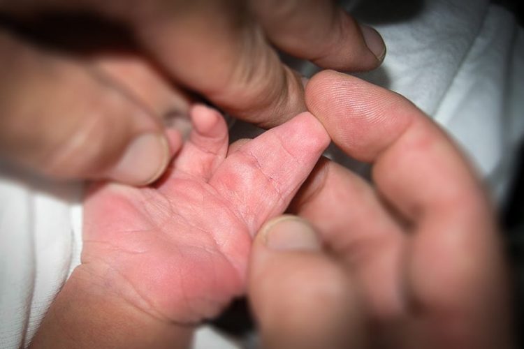 Doğuştan Yapışık Parmak (Sindaktili) Hastalığı, Tedavisi ve Ameliyatı - Doç. Dr. Burhan Özalp - İstanbul ve Diyarbakır Plastik ve Estetik Cerrahi